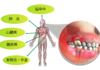 定期的な口腔内クリーニング　お薦めいたします
