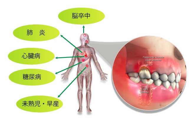 定期的な口腔内クリーニング　お薦めいたします